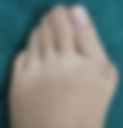 成都素美整形润致2号玻尿酸项目真人实例