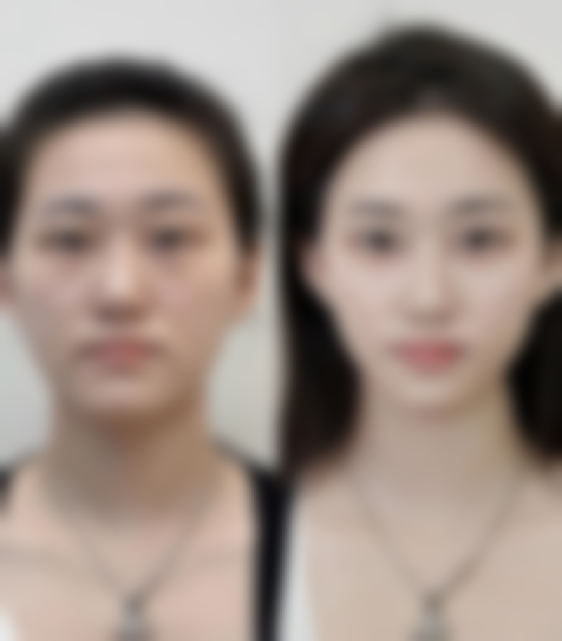 成都素美整形润致2号玻尿酸项目推荐医生