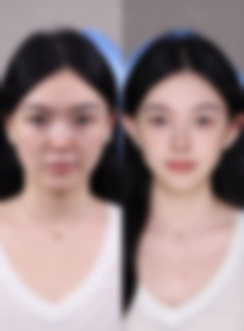 半岛第五代黄金微针价格与成效的关系