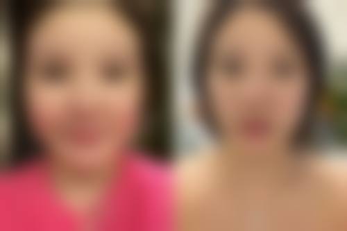 咬肌无力与表情僵硬：凹陷的隐藏信号