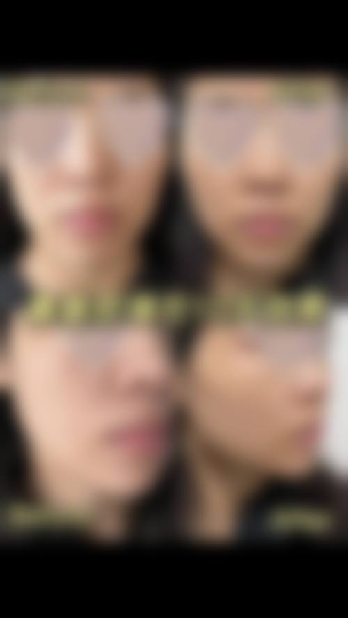 北京小美微针轻医美（北京合肥）真人口碑评价怎么样？