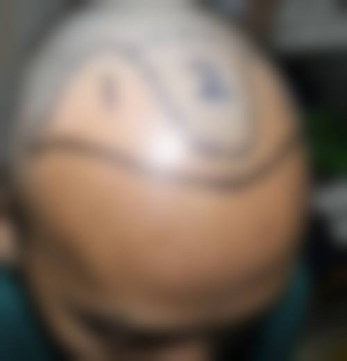 华美植发：性价比高的私人订制