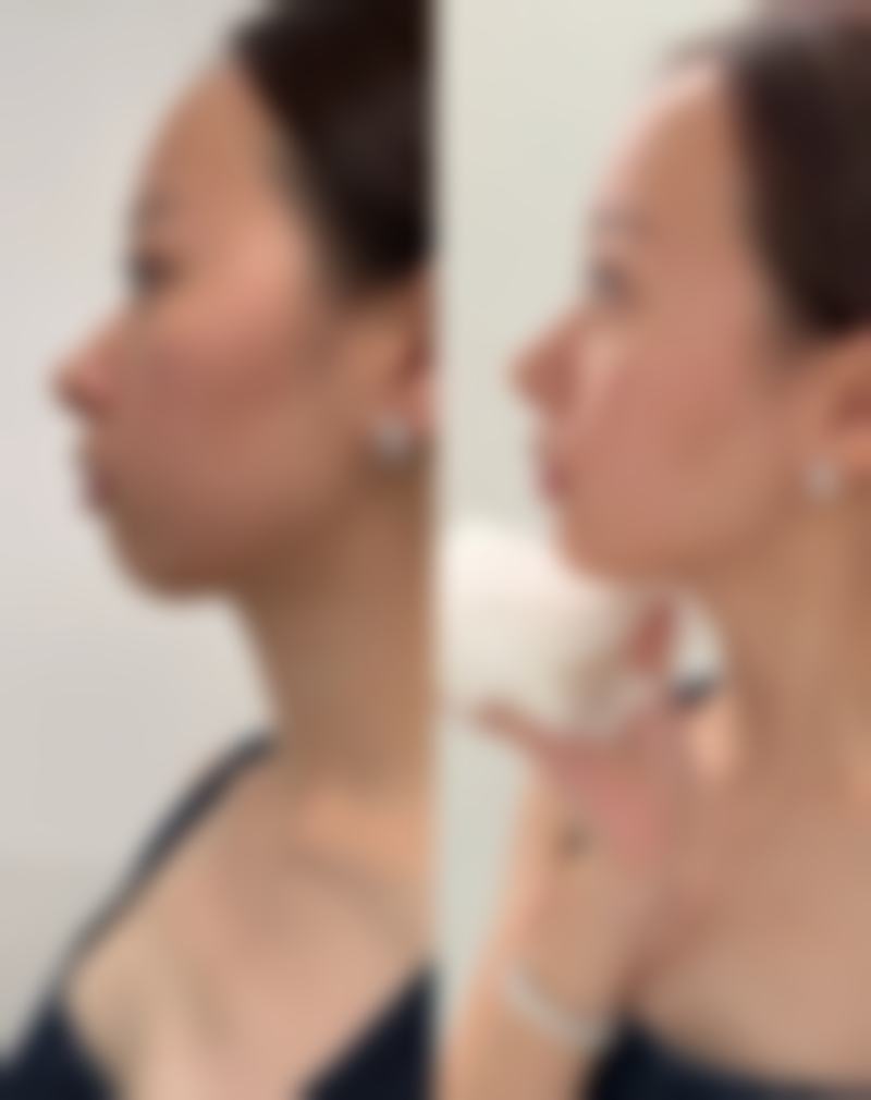 英国吉适除皱：6 - 8个月的长效美丽体验