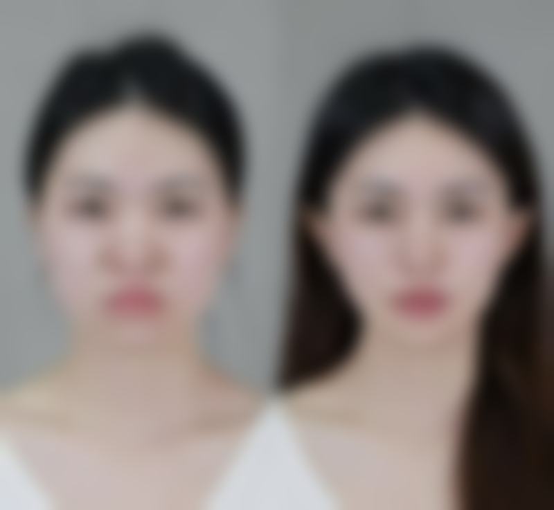 影响全切双眼皮消肿时间的关键因素