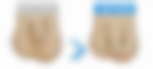 影响假体隆胸修复自然时间的因素