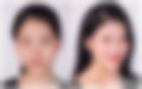 激光治疗：用光束重塑光滑肌肤