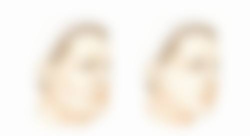 隆鼻假体取出要恢复多久？一般3 - 6个月，受个人体质、护理情况与手术复杂程度影响！ 