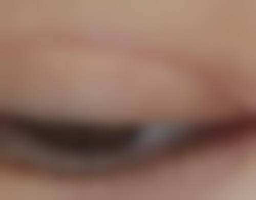 如何缩短割双眼皮的修复时间？