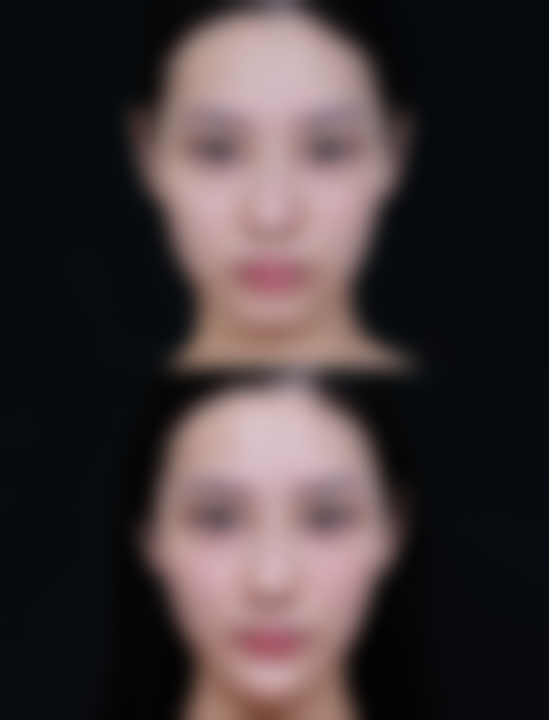 小腿吸脂技术亮点