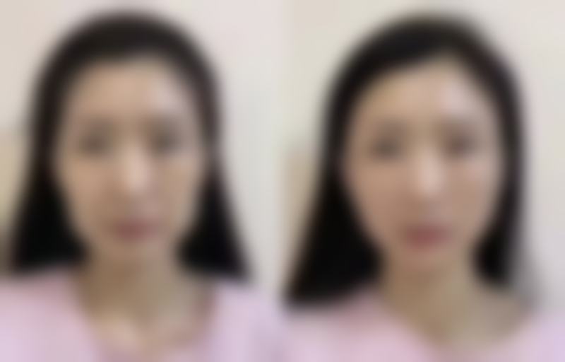 精心护理助力隆鼻假体取出后的快速修复