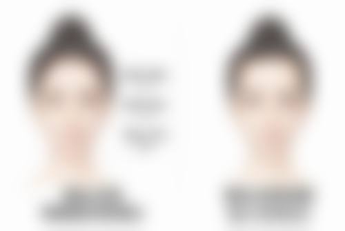 手术治疗：重度疤痕的有效选择