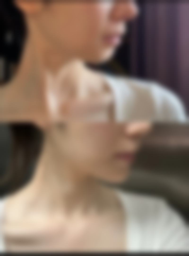 实例分析：疤痕体质滚针治疗的成败启示