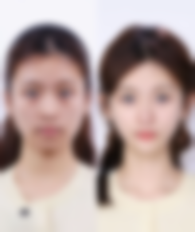 手术去眼袋内油脂：内切法的便捷之选