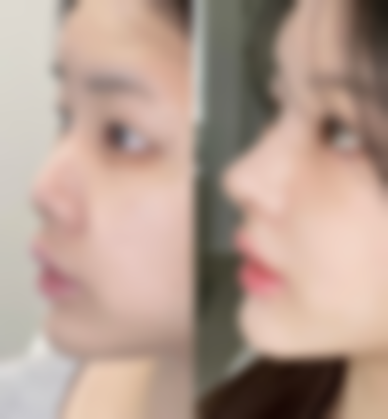 直观对比：眼袋与眼睑的症状表现差异