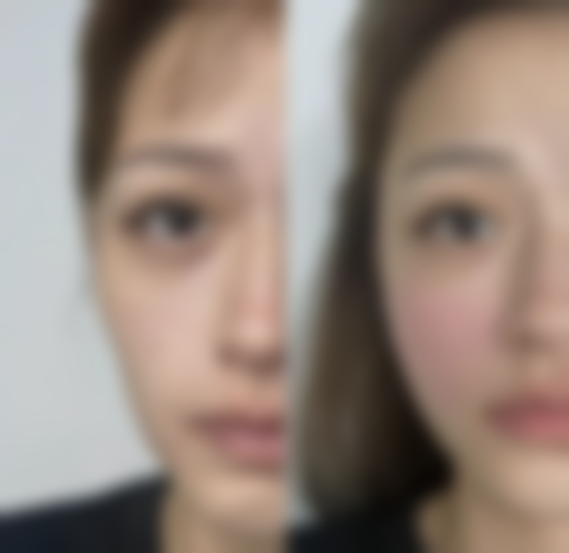 追根溯源：眼袋形成的原因与机制解析