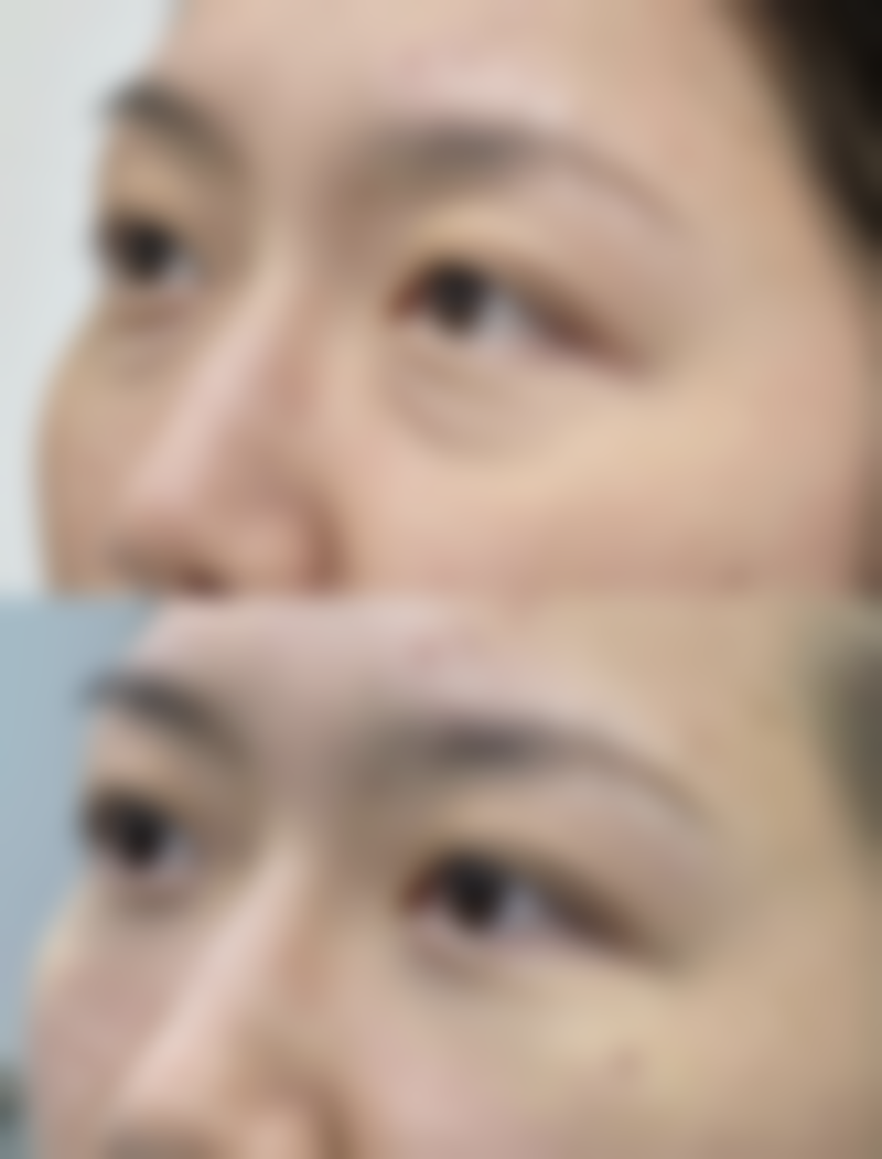 全切后做修复的注意事项与修复护理