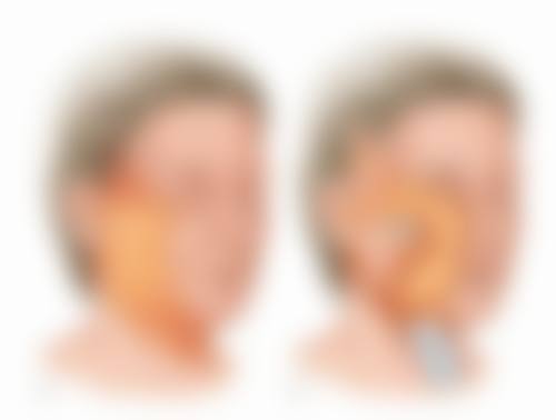 不同手术方式化眼妆时间大不同