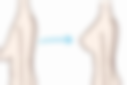 沈阳杏林张莹莹：“闭眼无痕”塑造天生般自然双眼皮