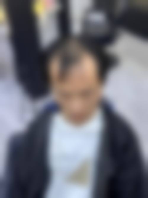 郑州华仁植发刘裴华医生植发效果及技术优势如何？艺术美学设计，毛囊成活率超95%！ 