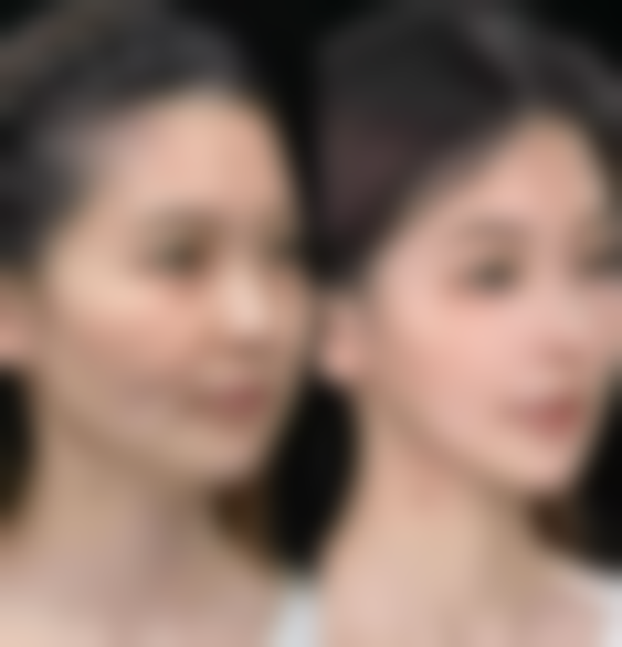 影响隆鼻可吸收线吸收时间的关键因素