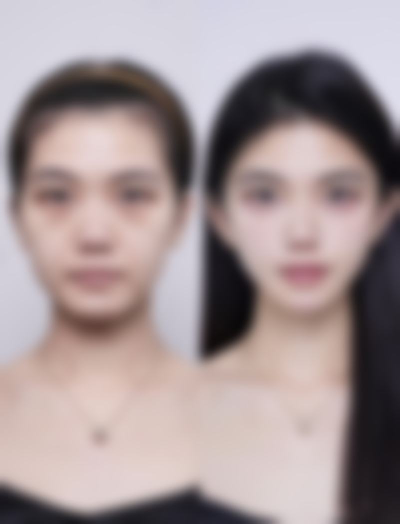 双眼皮开眼角修复的注意事项与禁忌