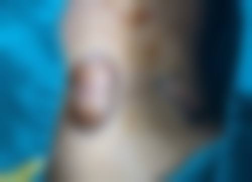 3 - 5 天后：可正常平躺，但仍需注意