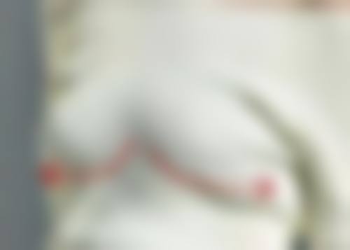 填充剂注射：便捷修复凹陷疤痕有妙招