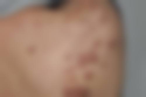 成都做疤痕最好的医院，成都军建医院SRT - 100祛疤800元起，口碑好值得信赖！ 