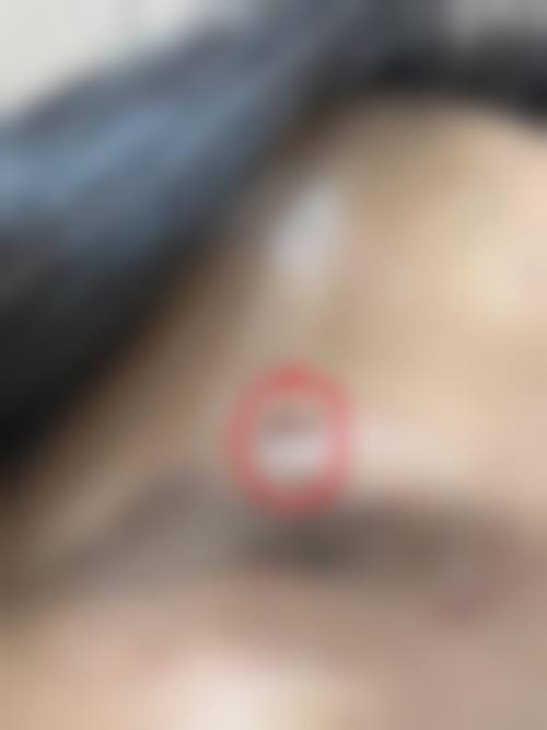 精良的祛疤技术与设备