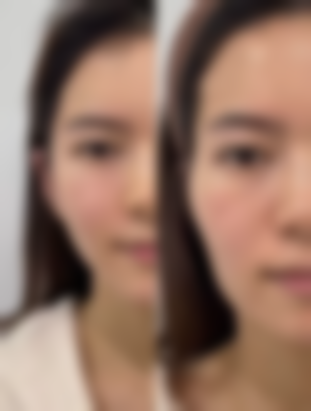 自体脂肪隆胸：2 - 3小时实现自然丰胸