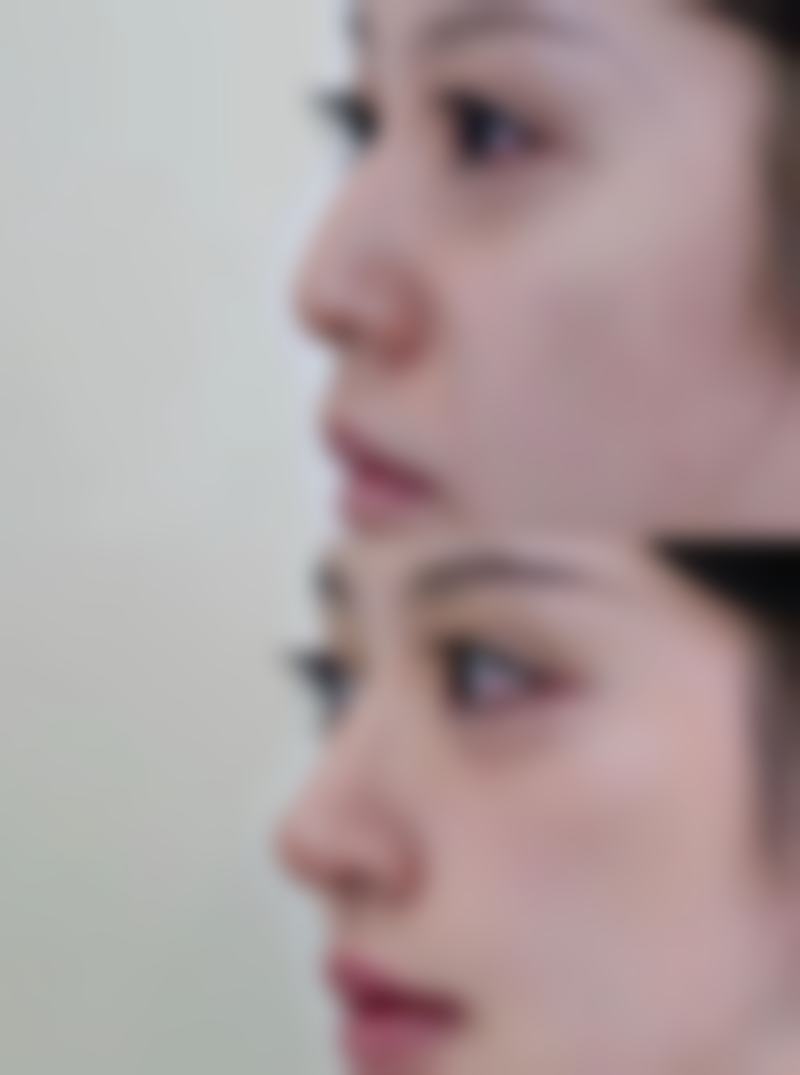 填充修复面部疤痕凹陷的方法与选择