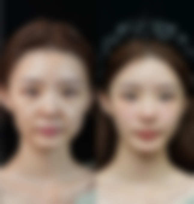 手术治疗：深度解决重度凹陷疤痕难题