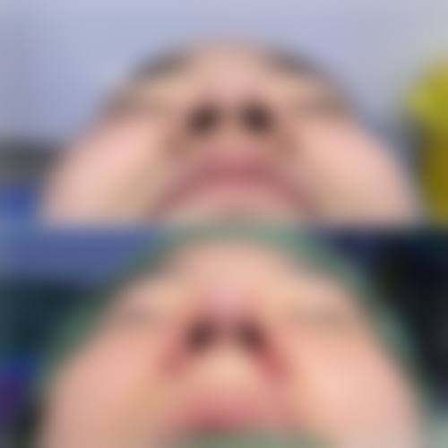 广西爱思特整形外科医院哪位医生好？刘晓军、高伟磨骨技术好，口碑获患者称赞！ 