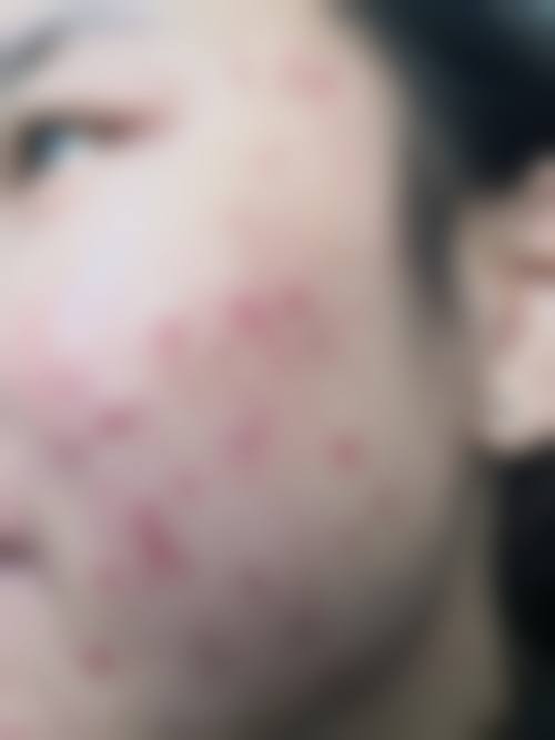 多维祛疤技术优势