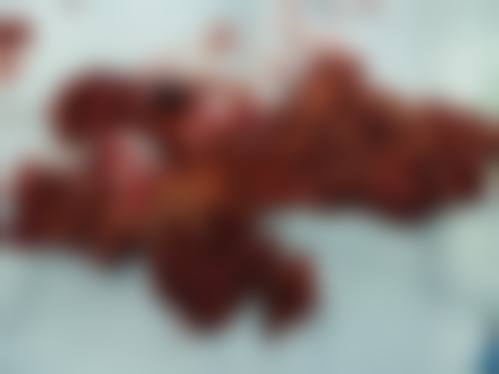 影响胸部奥美定取出费用的因素