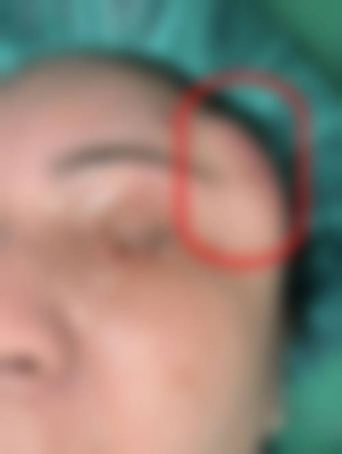 降低胸部奥美定取出费用的方法