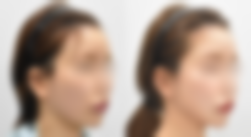 不同阶段的冰敷建议