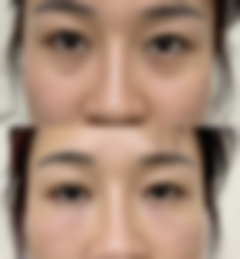 超弧刀治疗选择建议