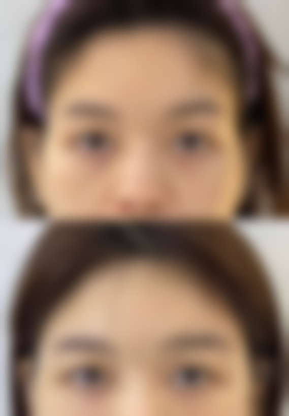 手术治疗：精细操作下的疤痕消除之旅