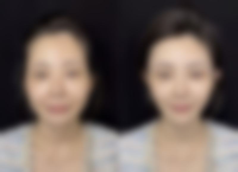 激光治疗疤痕增生的过程和注意事项