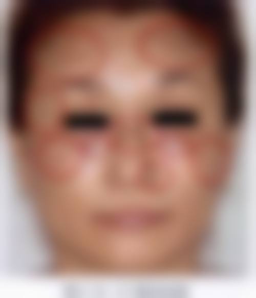 祛斑价格与优惠