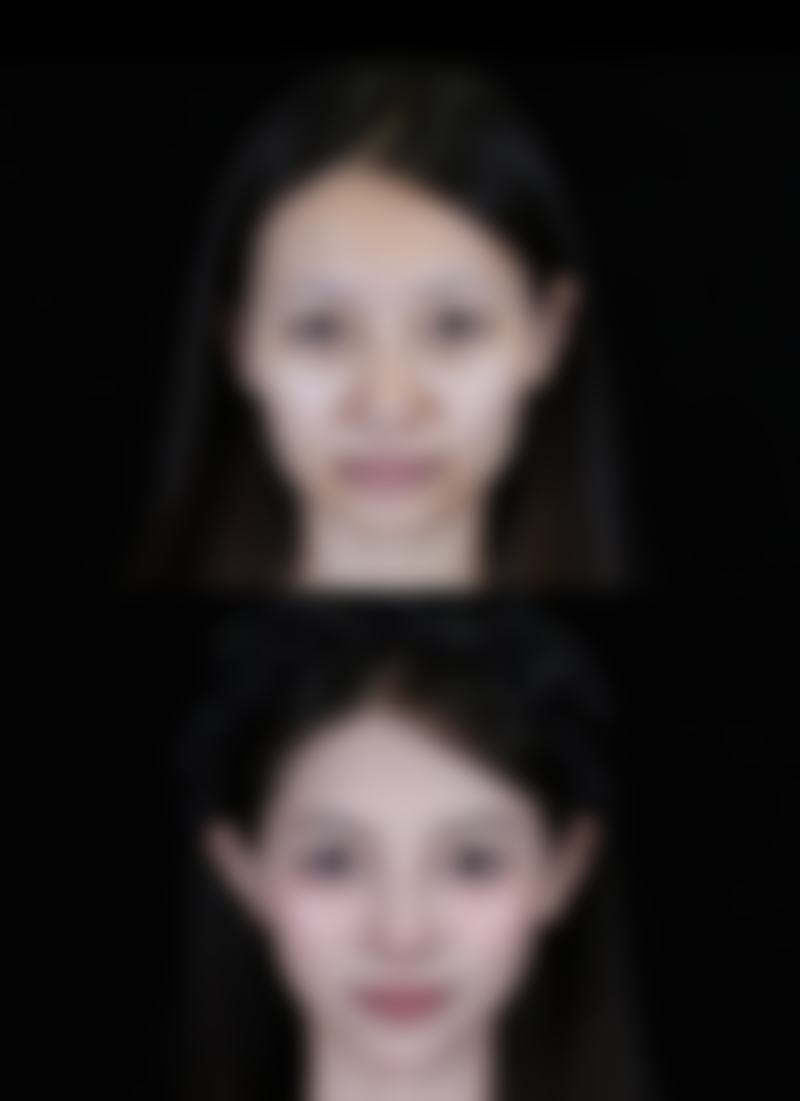 手术治疗：重度疤痕增生的有效解决方案