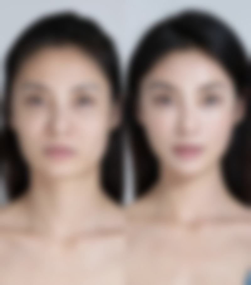 有医生生的膨体耳软骨隆鼻修复技术亮点