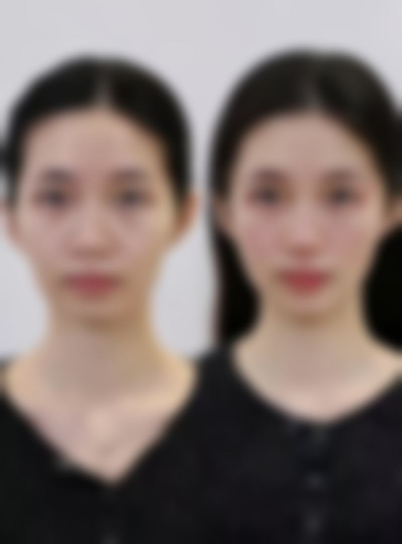 轻医美改善:温和出击,轻松应对轻中度眼袋