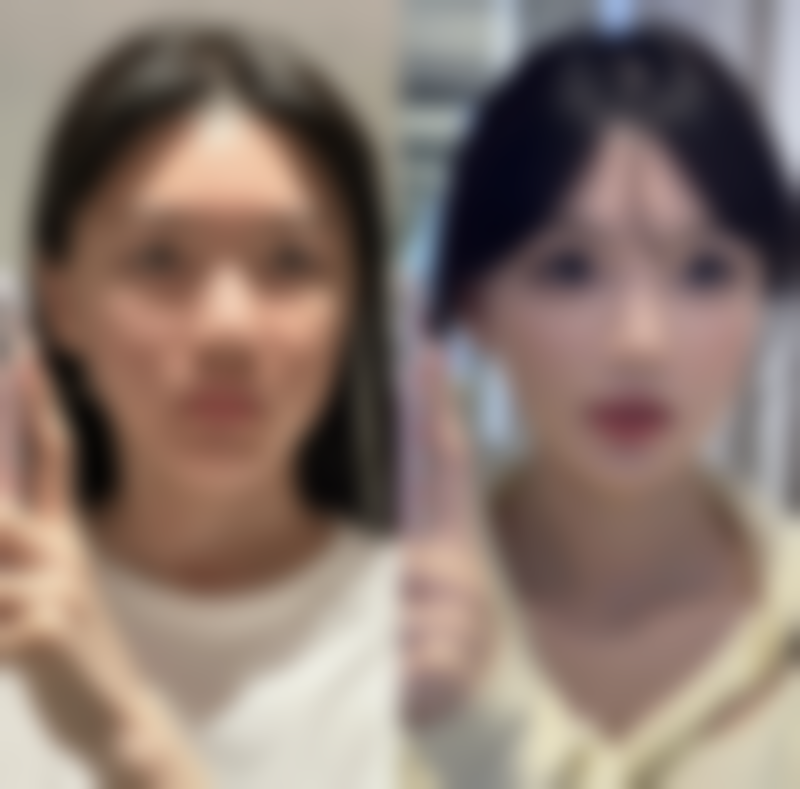 假体材料:经典隆鼻方式的多样选择