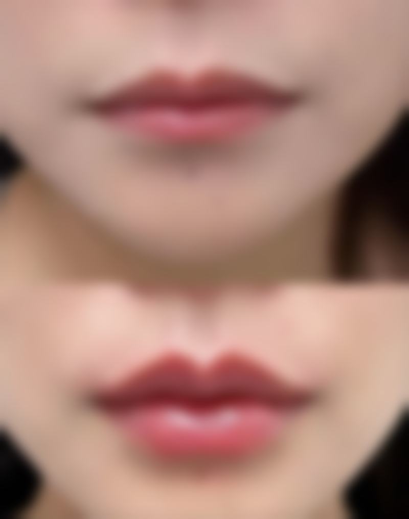 手术矫正:强力出击,中重度眼袋的克星