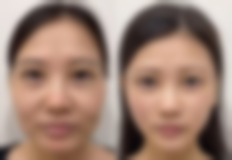 双眼皮手术技术优势