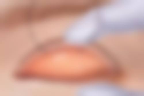 麻醉选择：让吸脂肪过程舒适无忧