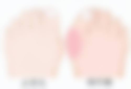 新兴疗法:SRT100浅放治疗