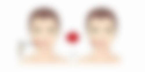 眼袋挖多了怎么办？先观察三个月，无效可做自体脂肪填充或玻尿酸注射修复